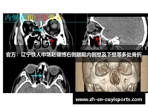官方：辽宁铁人中场赵健博右侧眼眶内侧壁及下壁等多处骨折